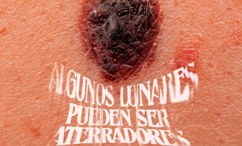 El melanoma, el monstruo más aterrador de Halloween