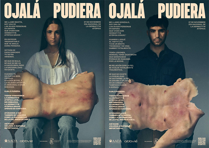 “Ojalá Pudiera” visibiliza la dermatitis atópica grave.