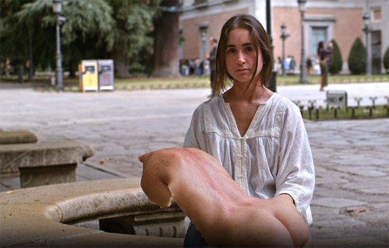 “Ojalá Pudiera” visibiliza la dermatitis atópica grave